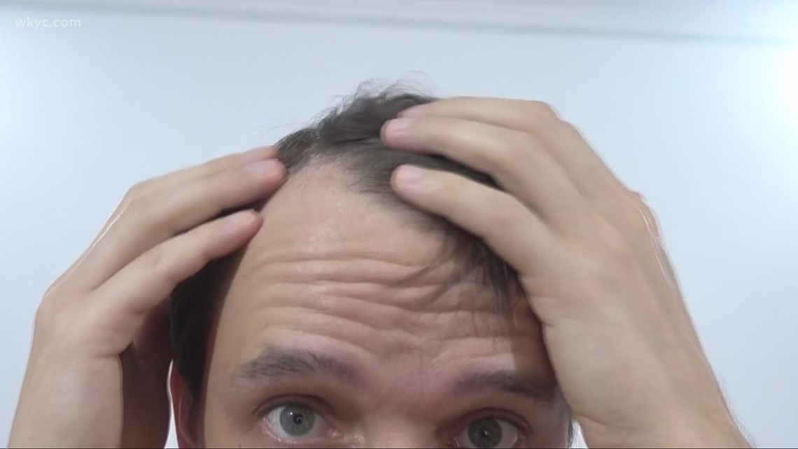 What To Do About Hair Loss Caused By Stress From COVID 19 Wkyc