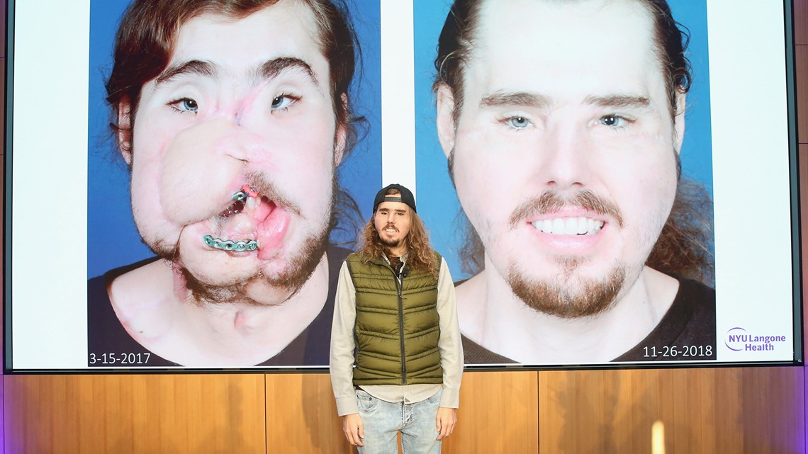 This Man's Face Transplant Story Is Incredibly Inspiring