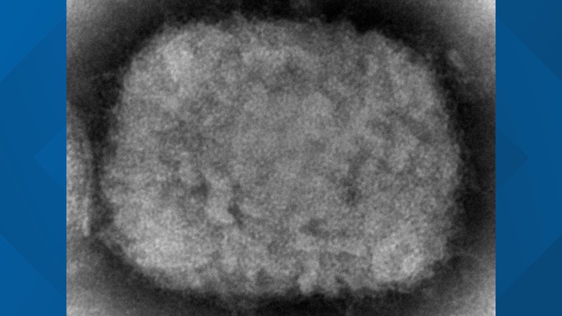 Massachusetts Man Contracts First Case of U.S. Monkeypox in 2022