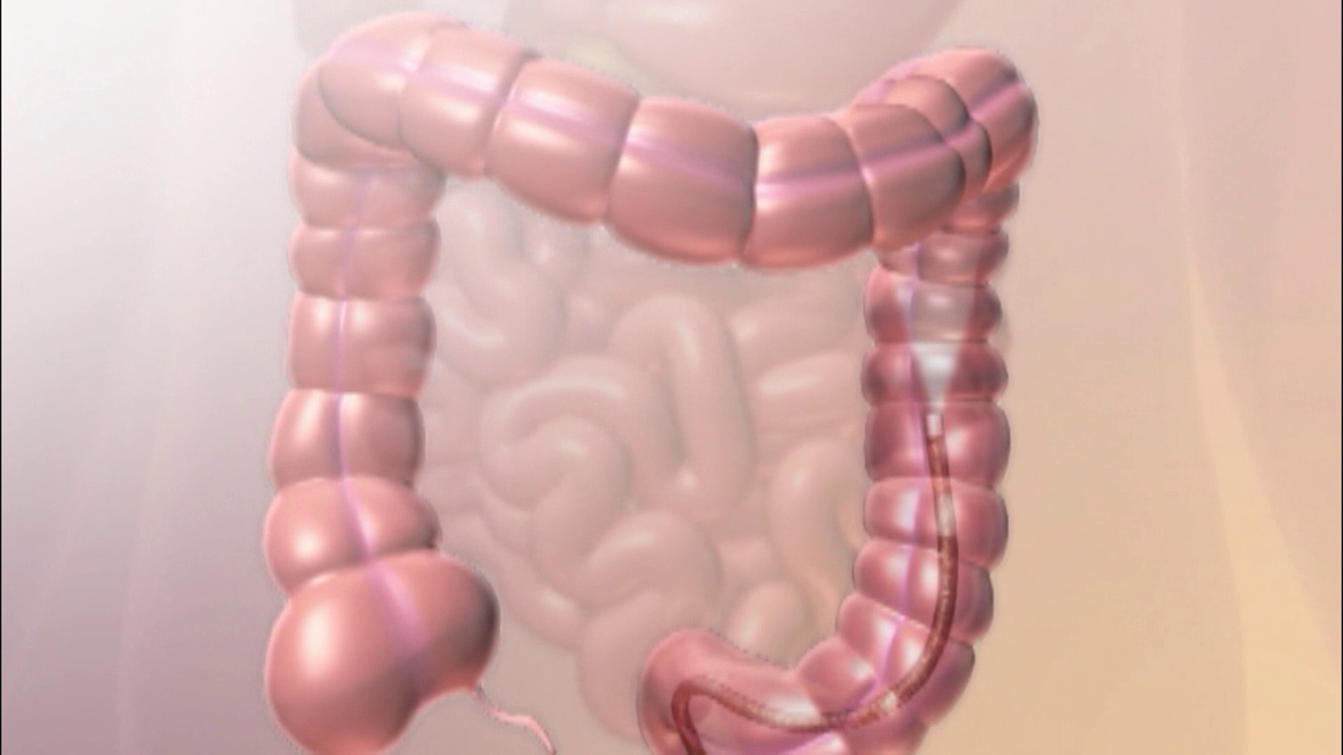 専用ページ colon様8/31 Colorectal cancer screening guidelines updated to include blood