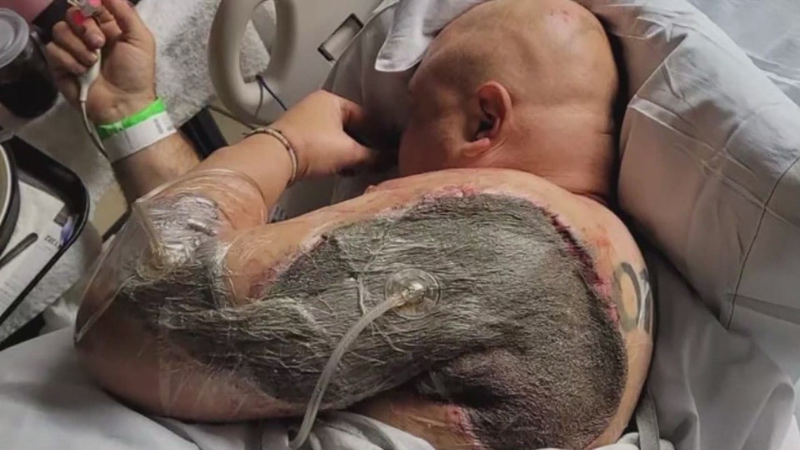 Man suffers serious burns after passing out on hot Mesa pavement - Vimarsana News