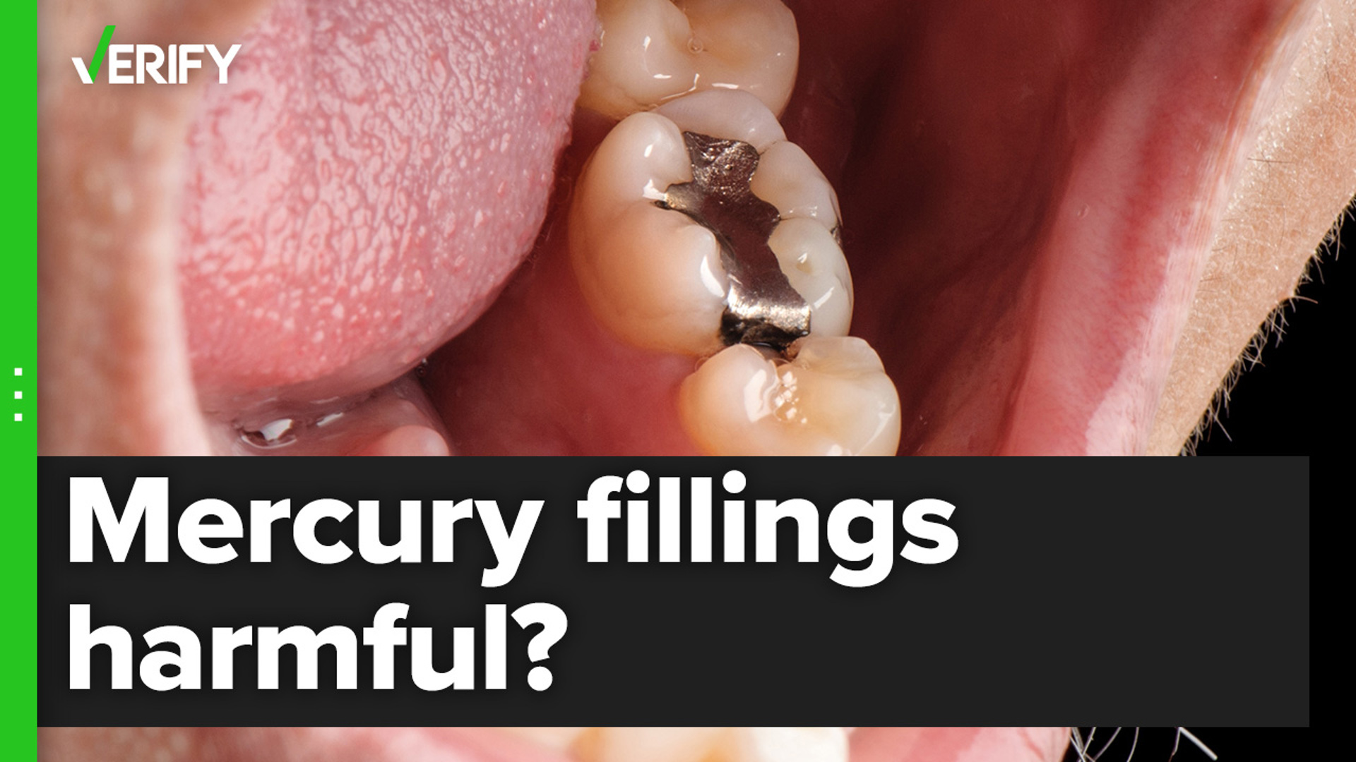 Mercury dental amalgam fillings are safe for most people