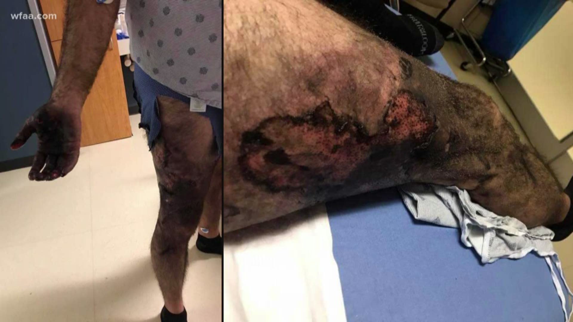 Man burned by exploding e cigarette