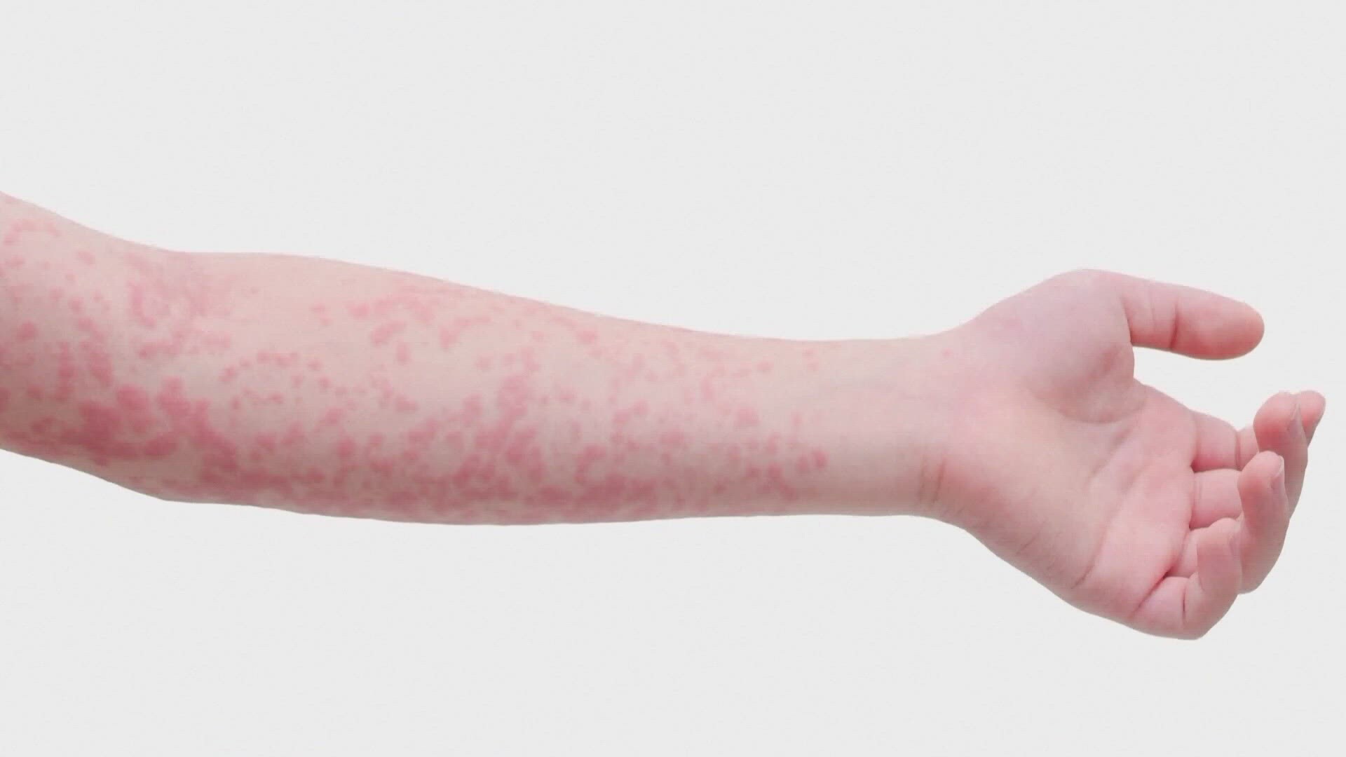 The state had one measles case reported last year, and 90 reported in 2022.