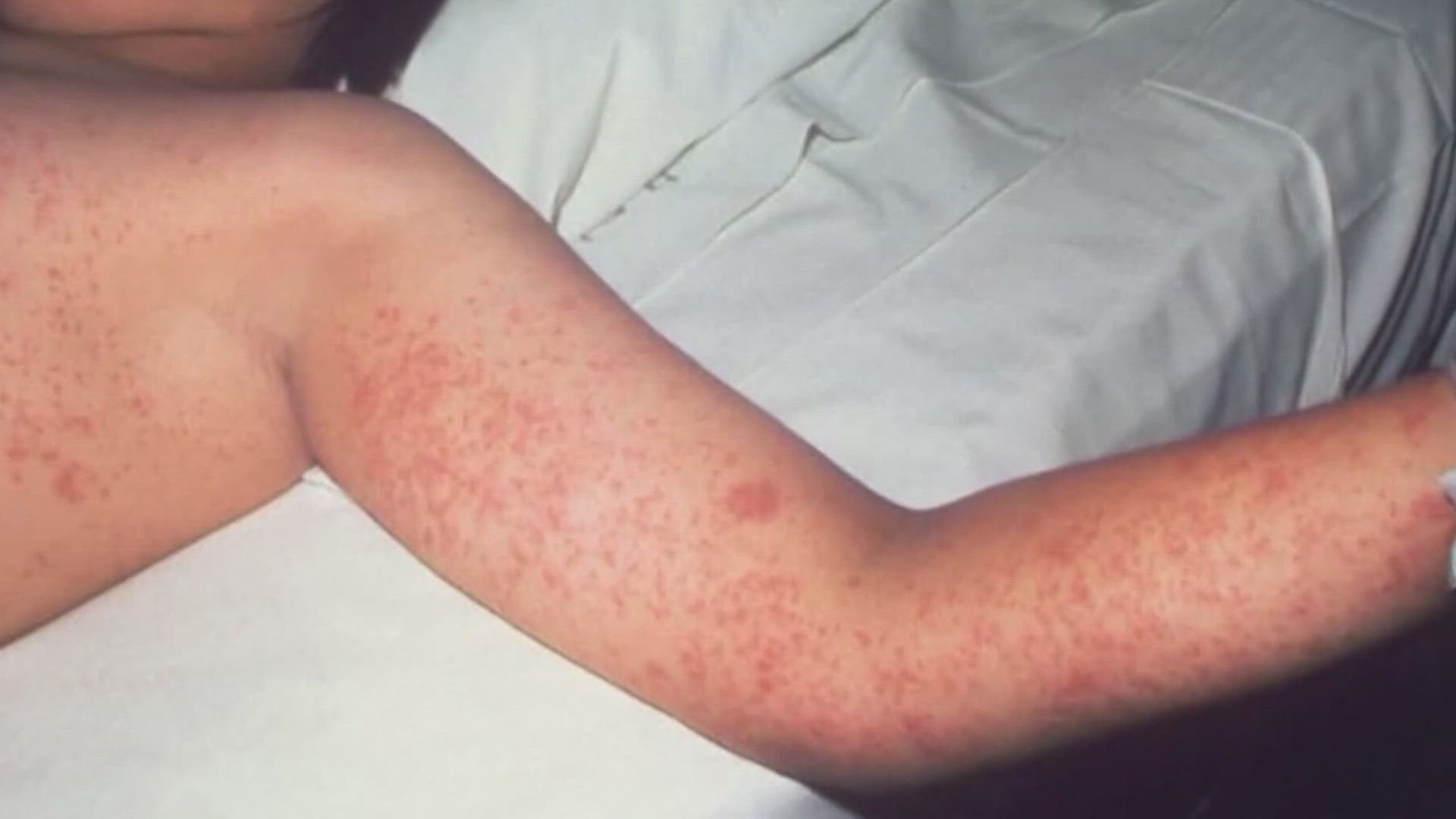 Measles is caused by a highly contagious virus that’s airborne and spreads easily when an infected person breathes, sneezes or coughs.
