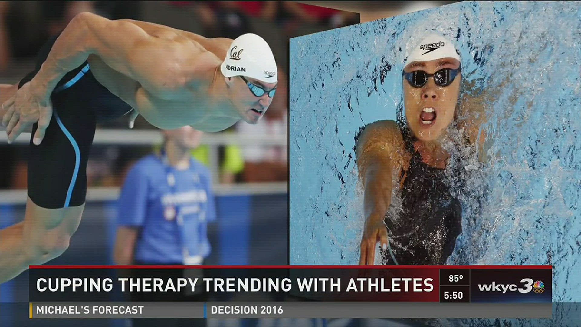 Cupping therapy trending with athletes