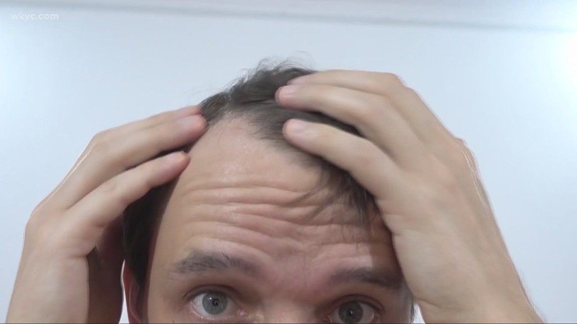 What to do about hair loss caused by stress from COVID19