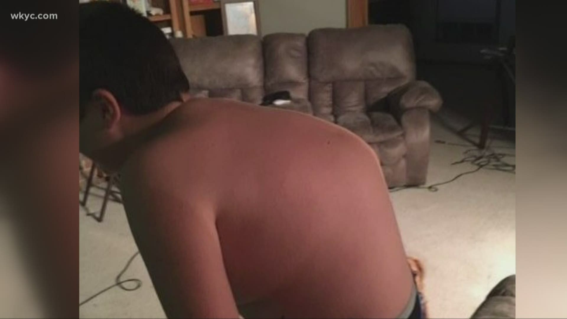 Logan Elliott, 16, suffers from a spinal condition called kyphosis. Two years ago, puberty caused his back to curve at a sharp angle.