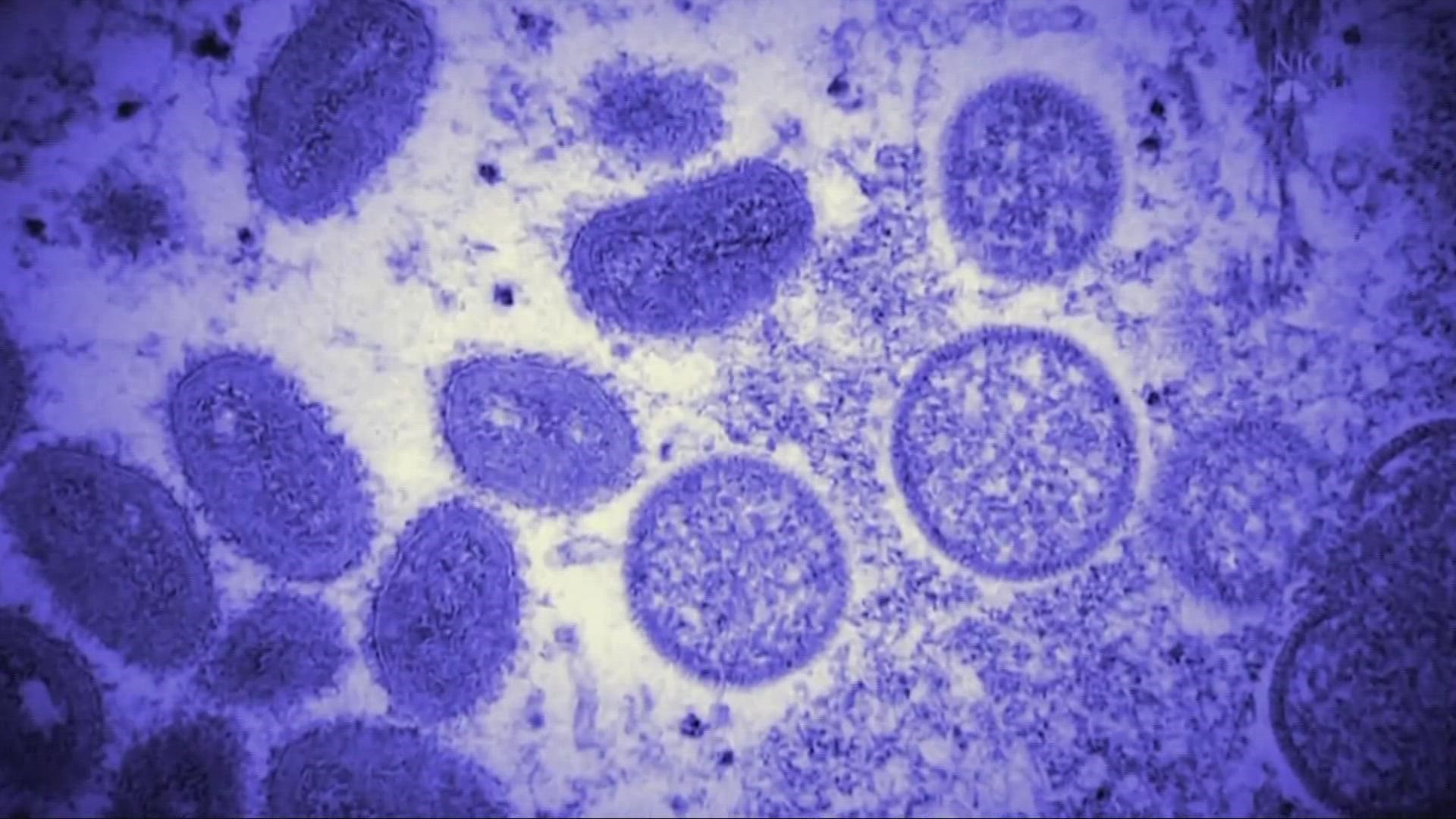 There are now 18 cases of monkeypox in Cleveland, and two cases in Lorain County.