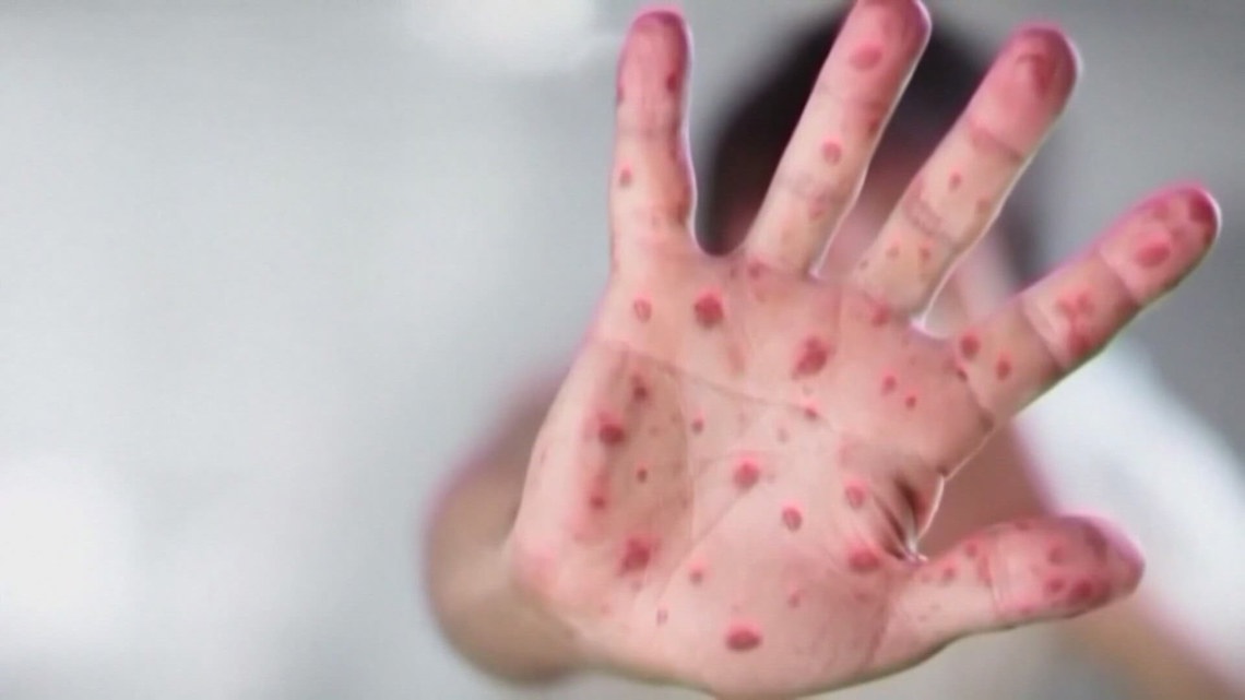 Measles outbreaks threaten to end the US's disease-free status