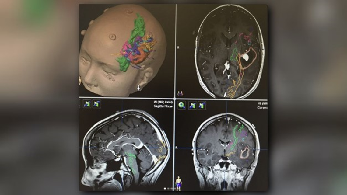 Lung cancer brain metastases prognosis