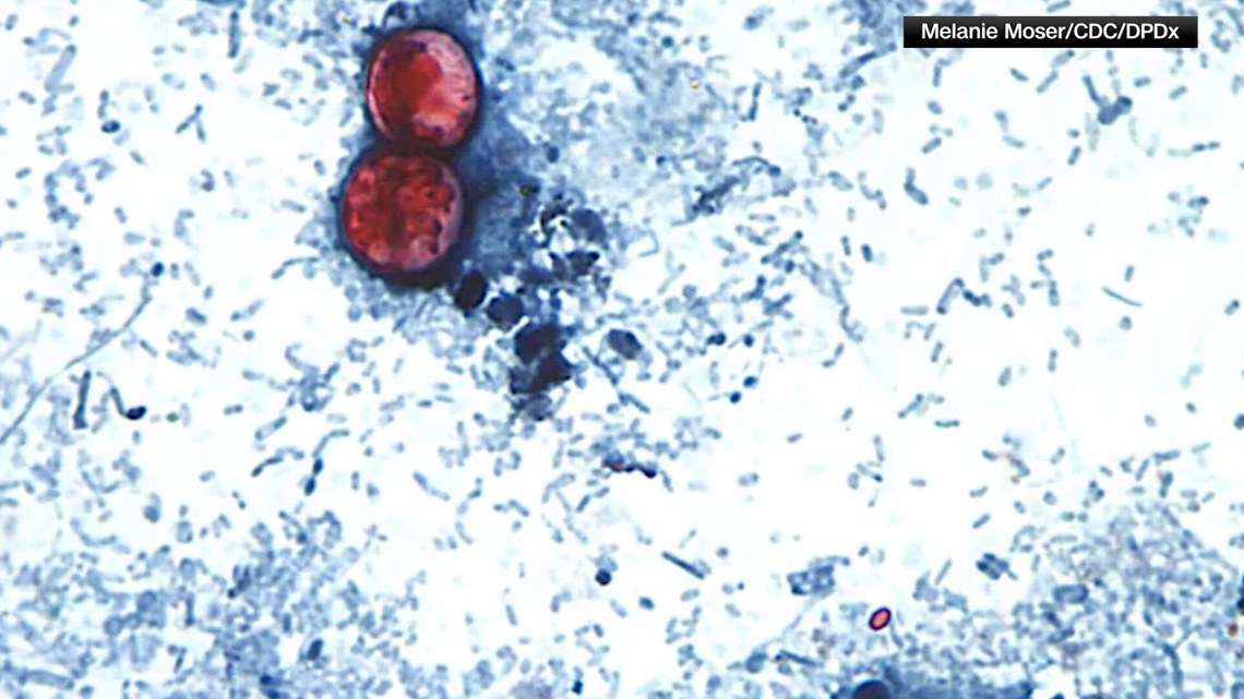 Cyclospora cases surging across Midwest: Cleveland Clinic lab sees testing jump from 1 per day to nearly 200
