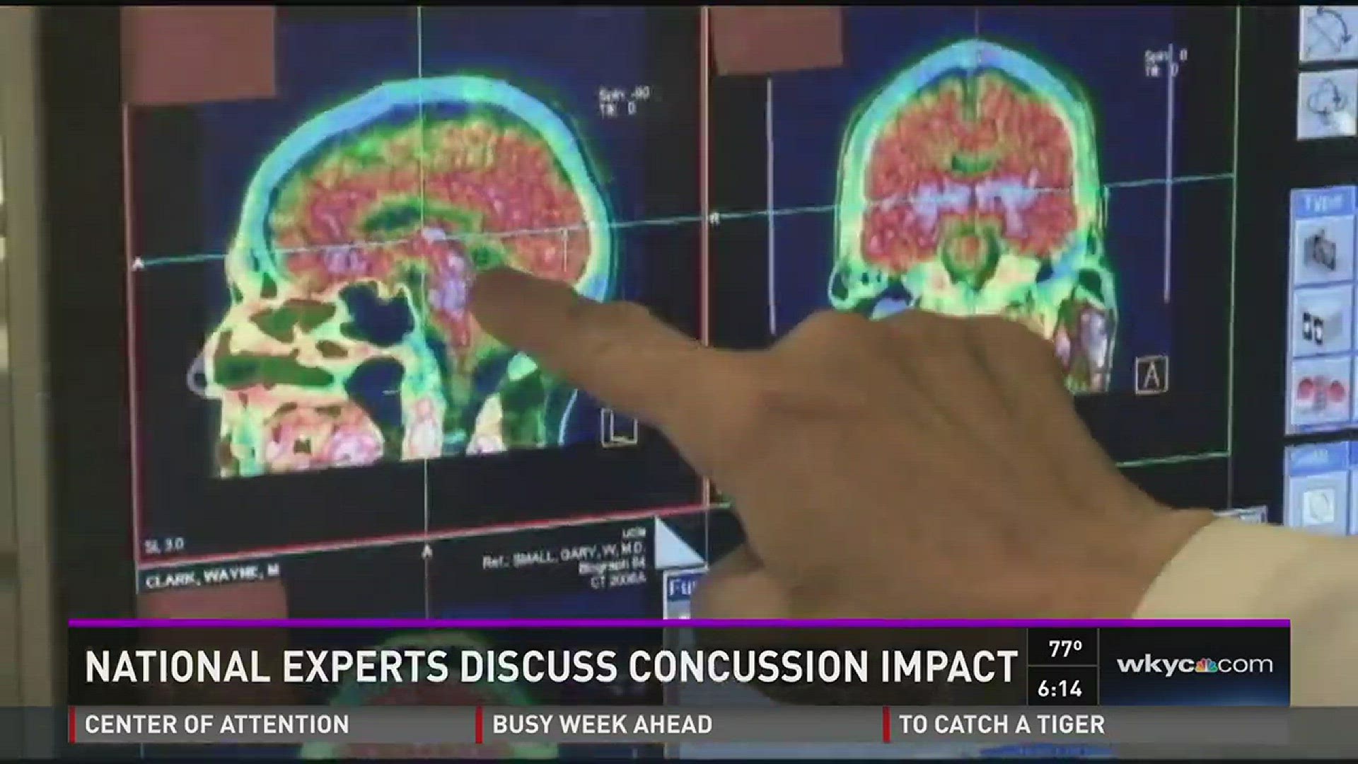 June 23, 2015: Nation's experts visit Cleveland for concussion discussion