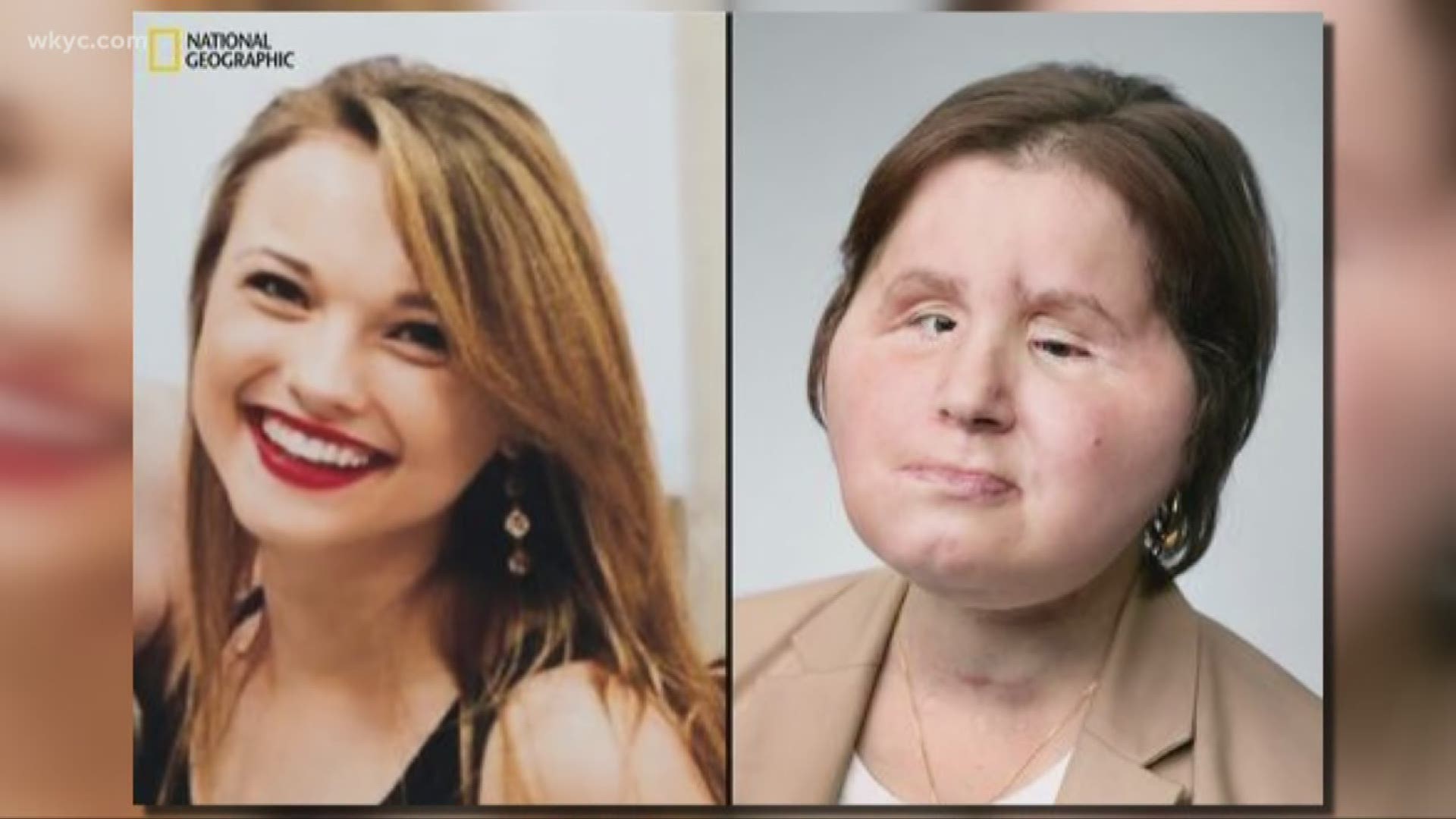 Face transplant recipient gets second chance after failed suicide attempt