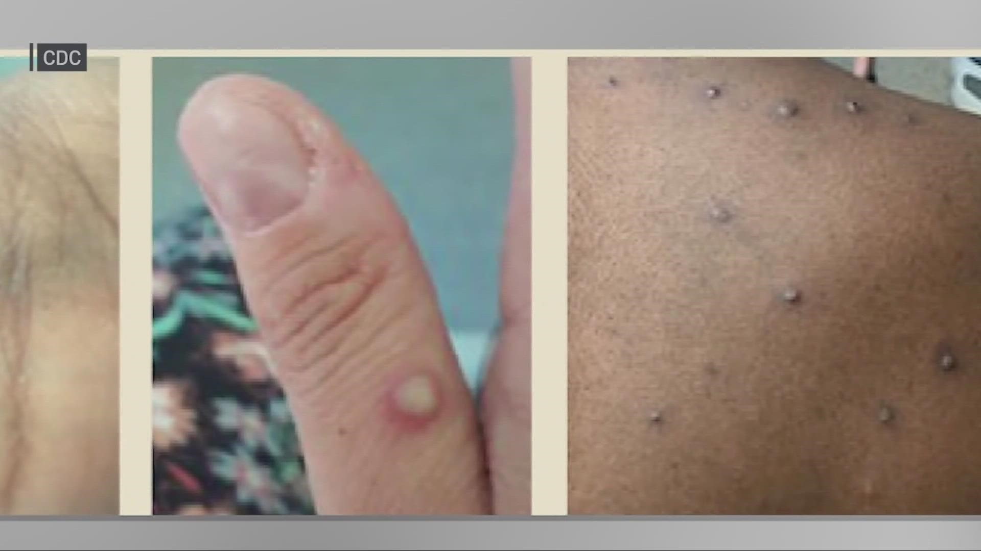 College students are being warned to pay attention to reports about Monkeypox