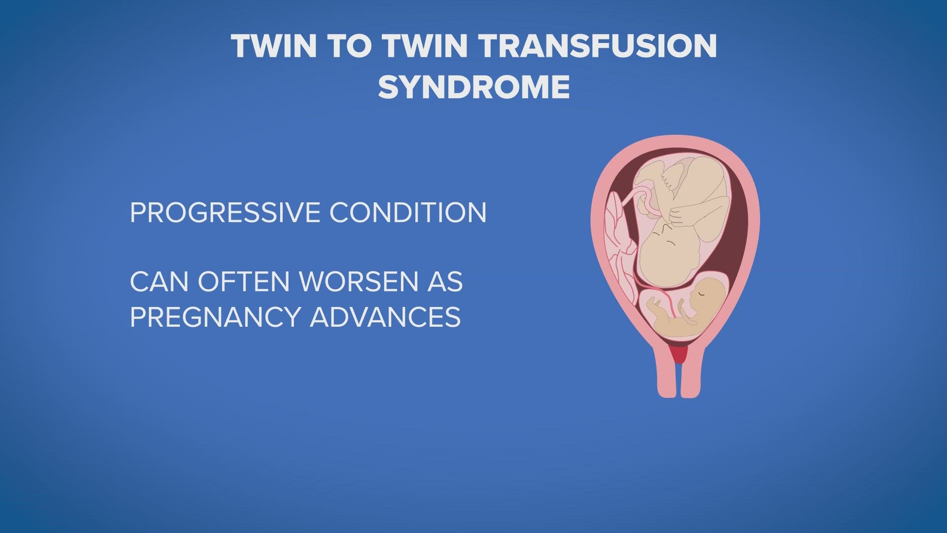 Twin-Twin Transfusion Syndrome, or TTTS, is a rare condition that can advance to critical stages in a matter of days. UH is at the forefront of a new procedure.