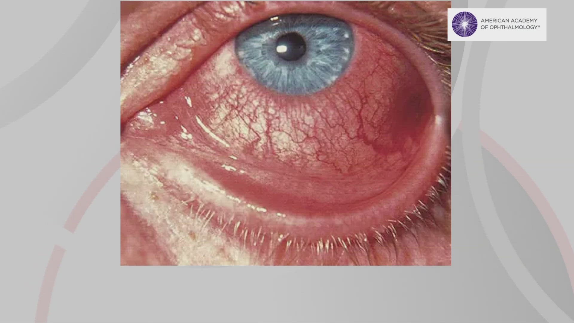 A new COVID variant that is spreading across the US may cause conjunctivitis, a common eye infection known as pink eye.
