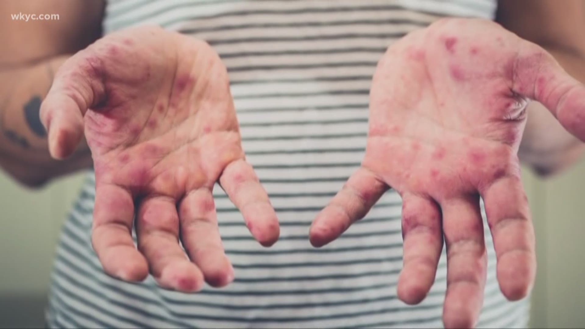 The Ohio Department on Health has confirmed the state's first measles case of 2019.  The department says the patient is an unvaccinated young adult from Stark County who recently traveled to a state with confirmed measles cases.