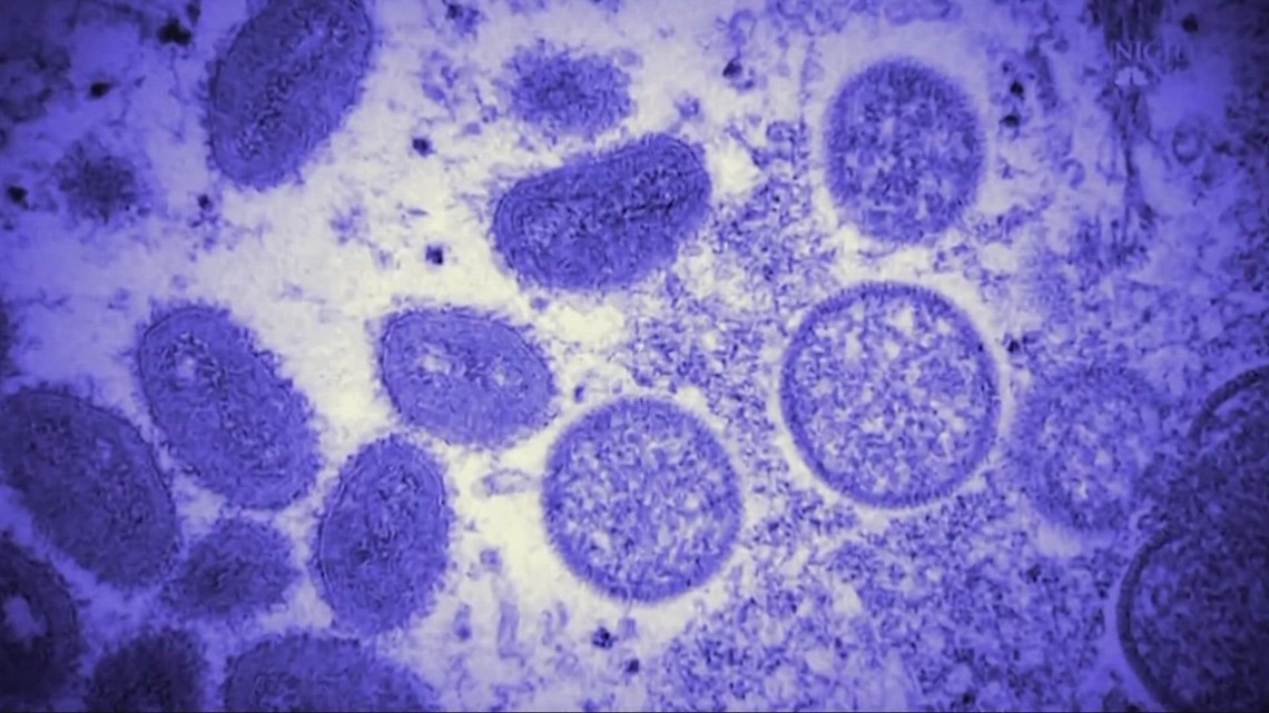 Ohio Department of Health reports first monkeypox death in the state