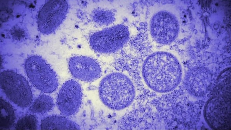 'A downward slope': Monkeypox cases starting to decline in Cleveland and across Ohio