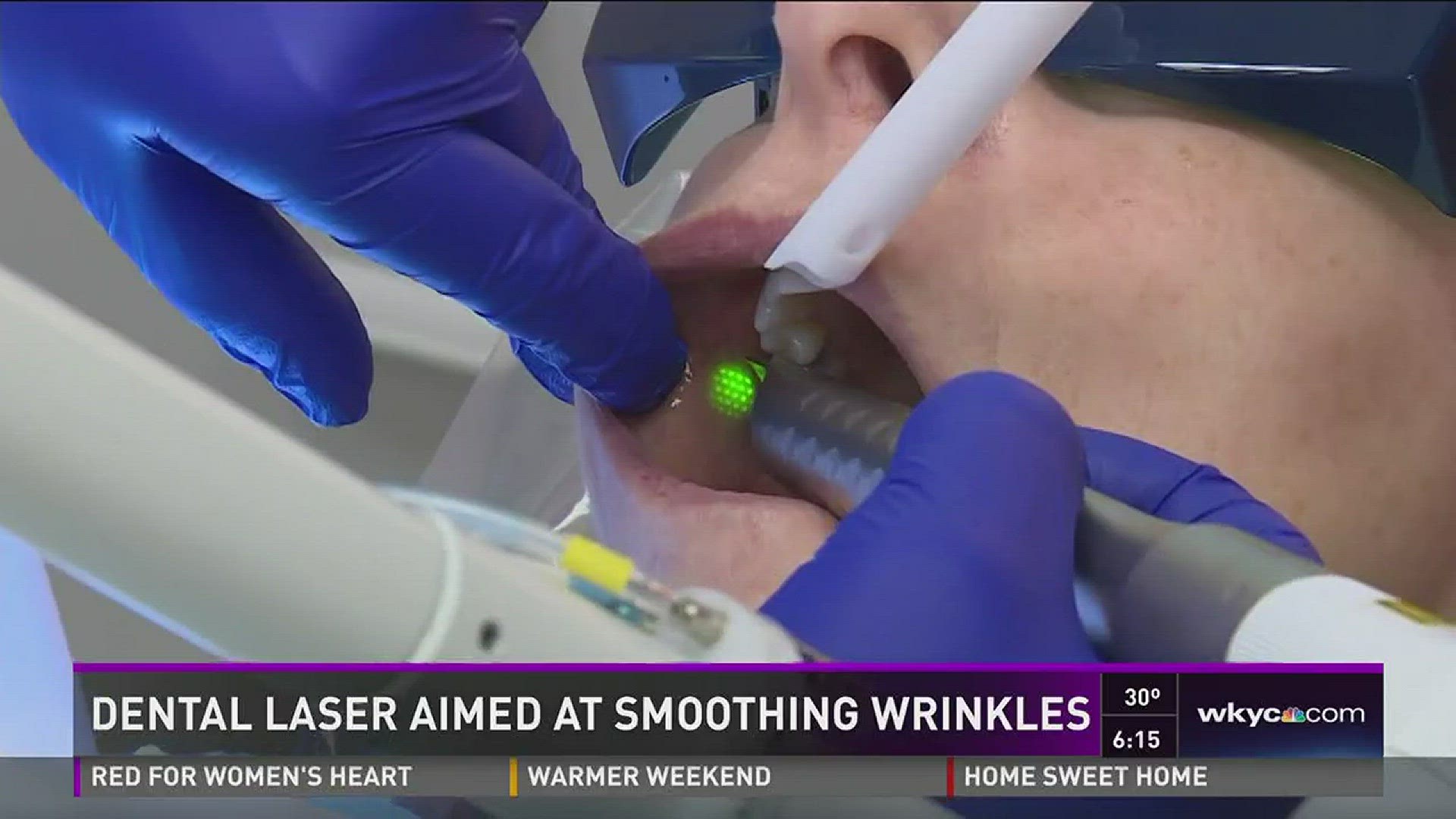 Dental laser aimed at smoothing wrinkles
