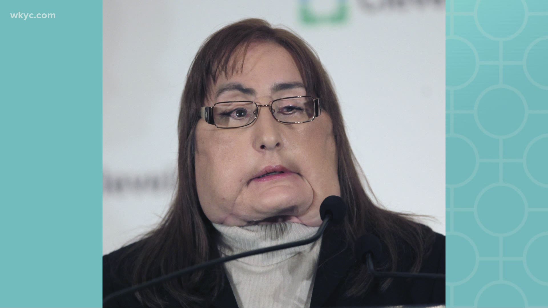 Culp was the first near-total face transplant recipient in the US. The procedure was performed at the clinic back in 2008, after her husband shot her.