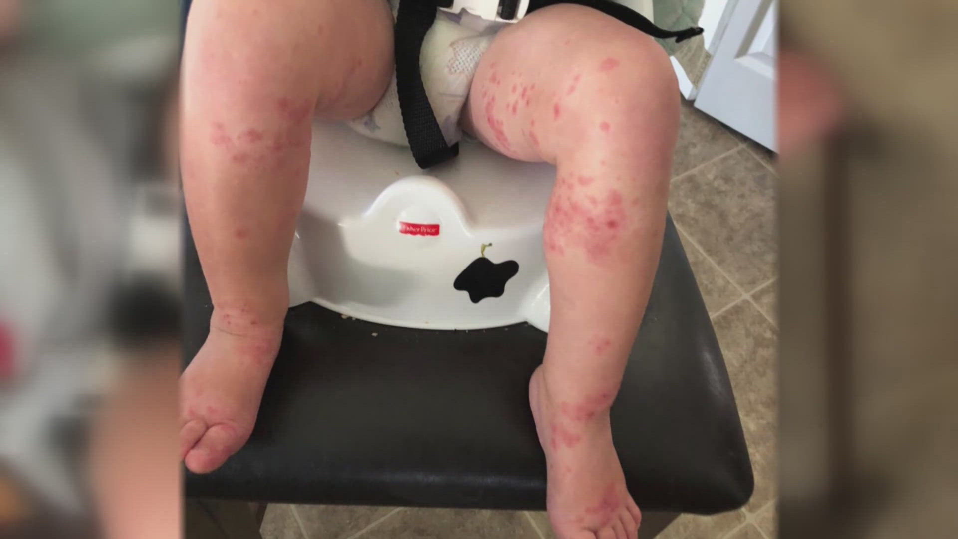 The cancellation of an Akron area high school football game is prompting new warnings from health officials about the spread of hand, foot and mouth disease.