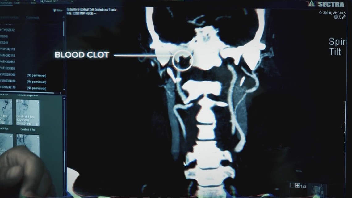 Stroke in the MRI: How a UH executive made a lifesaving decision - Vimarsana News