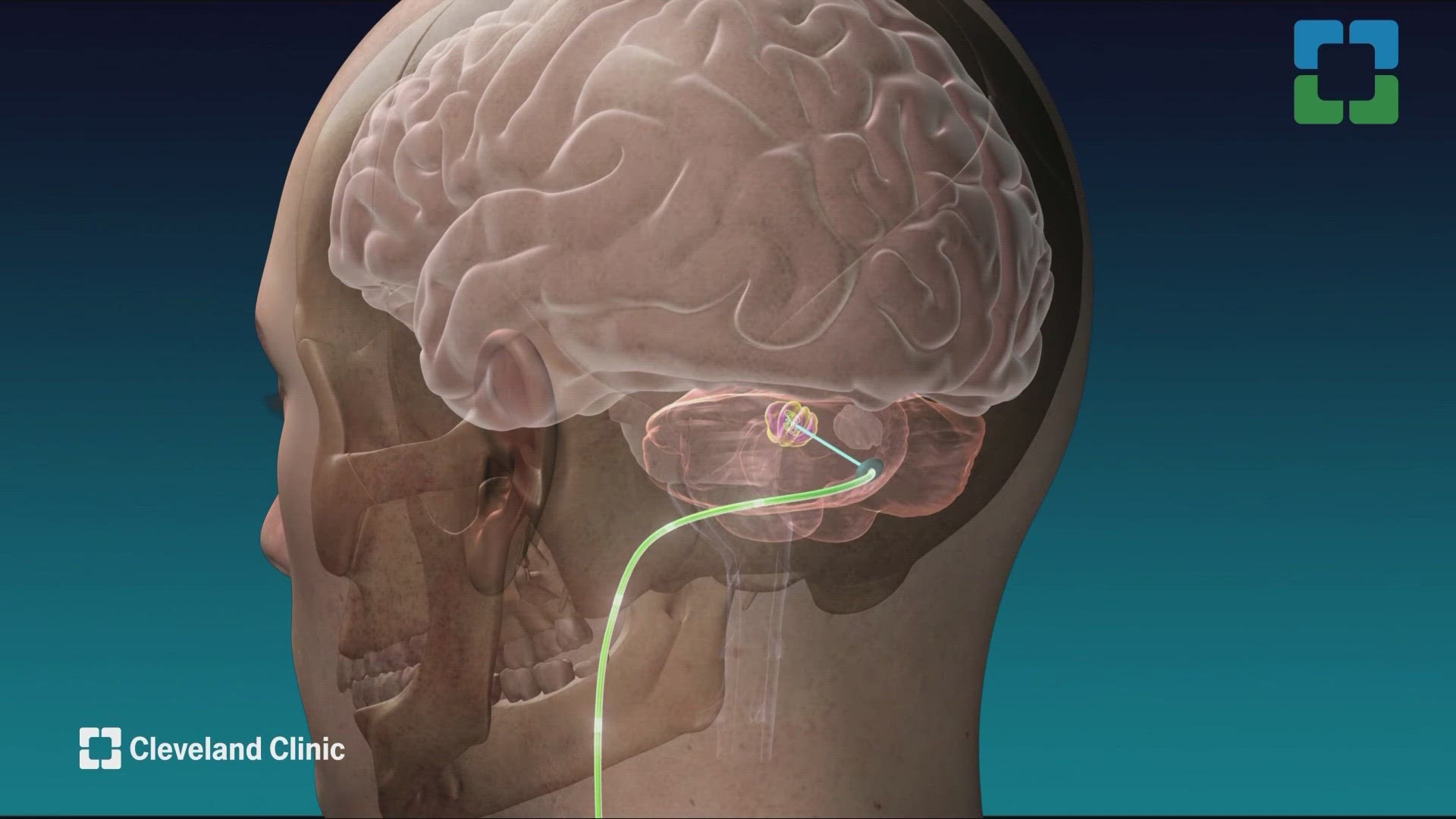 Cleveland Clinic just released data of ground-breaking research regarding stroke recovery.