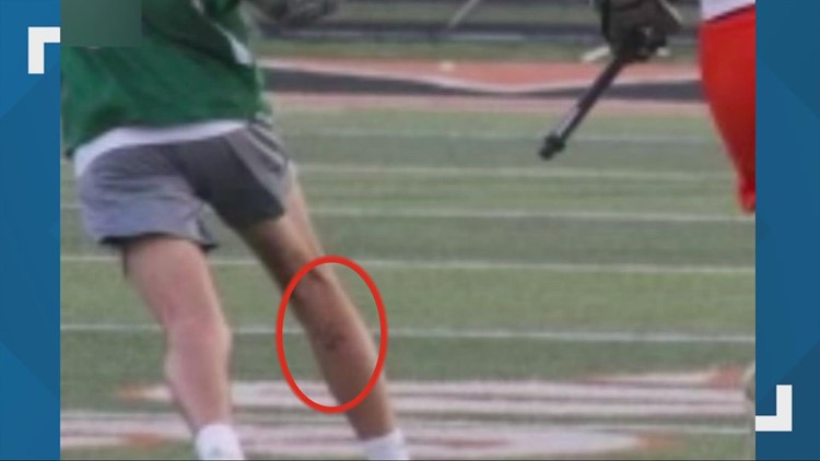 Lake Catholic High School lacrosse player accused of painting swastika on leg during game against Orange