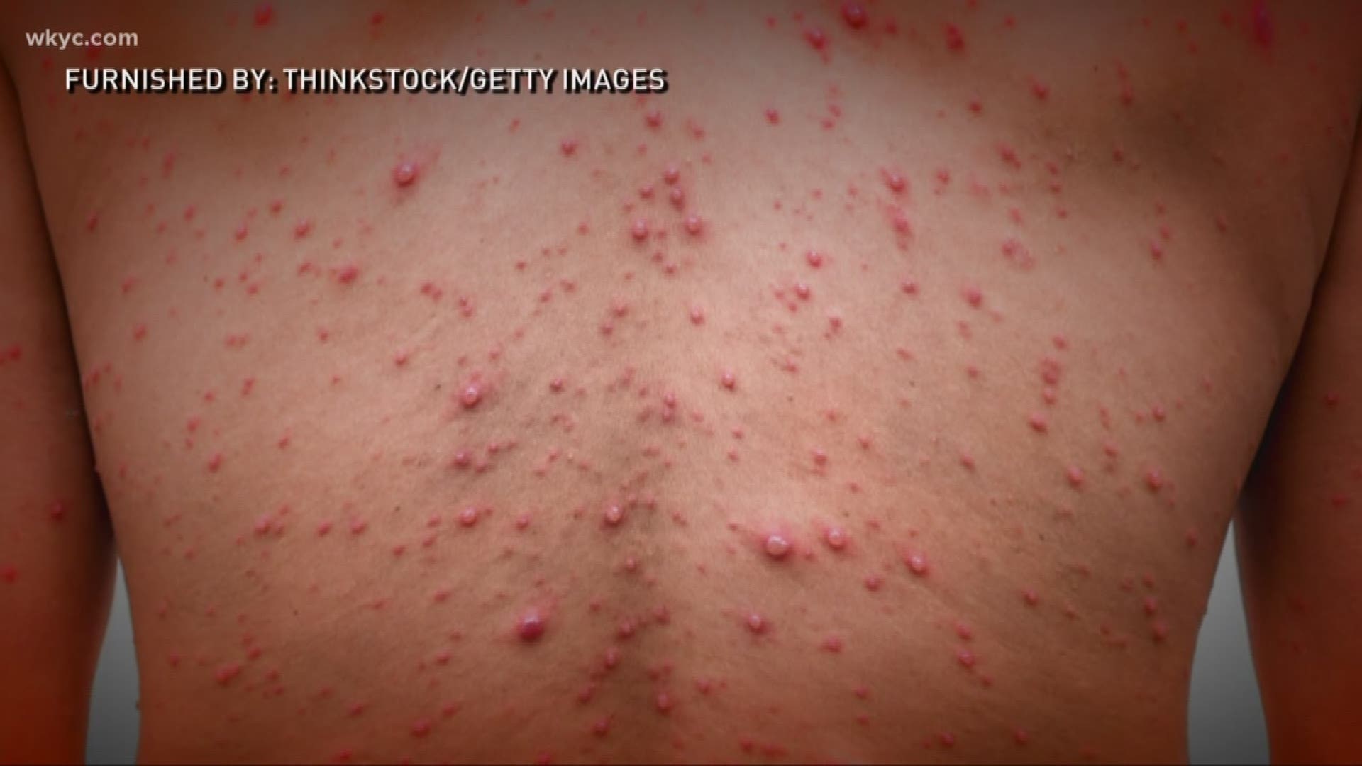Nov. 7, 2018: You've probably heard that some people purposely expose their children to chicken pox. But doctors are warning parents about 'chicken pox parties,' saying this is not something to take lightly.