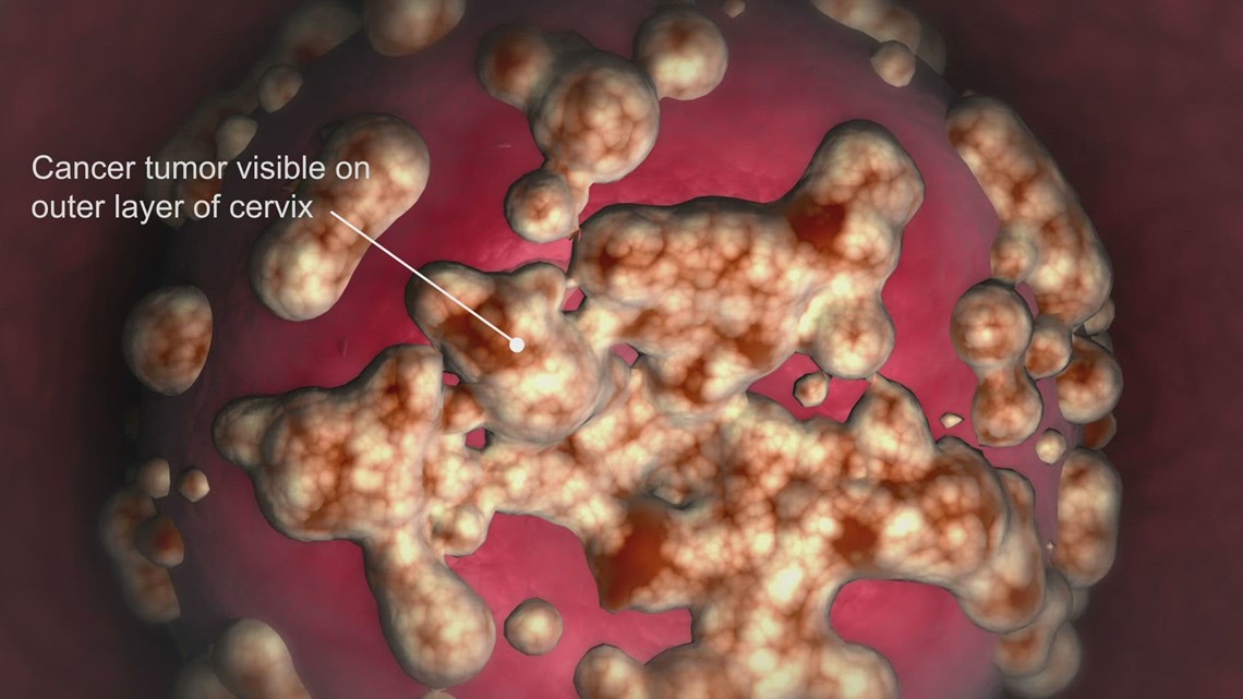 Cervical Cancer Awareness Month: Cases rising for some women - Vimarsana News