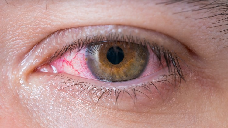 Can COVID-19 cause pink eye?