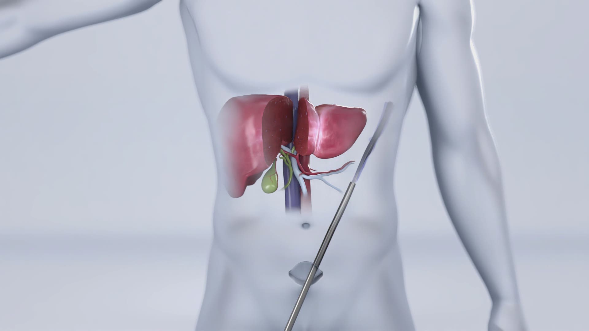 The Cleveland Clinic has achieved another medical advancement by successfully performing their first purely laparoscopic living donor surgery for liver transplant.
