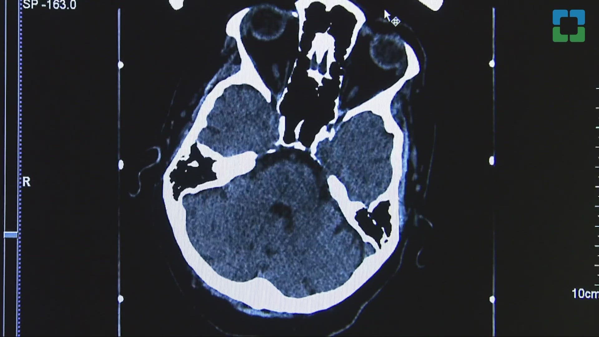 Cleveland Clinic releases results of a phase 1 trial using Deep Brain Stimulation to help long-term, post-stroke patients regain movement in upper extremities.