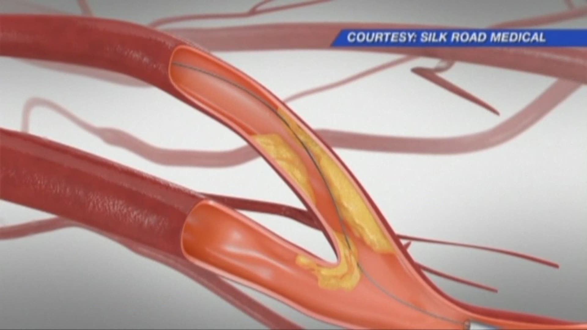 New treatment for plaque buildup in arteries