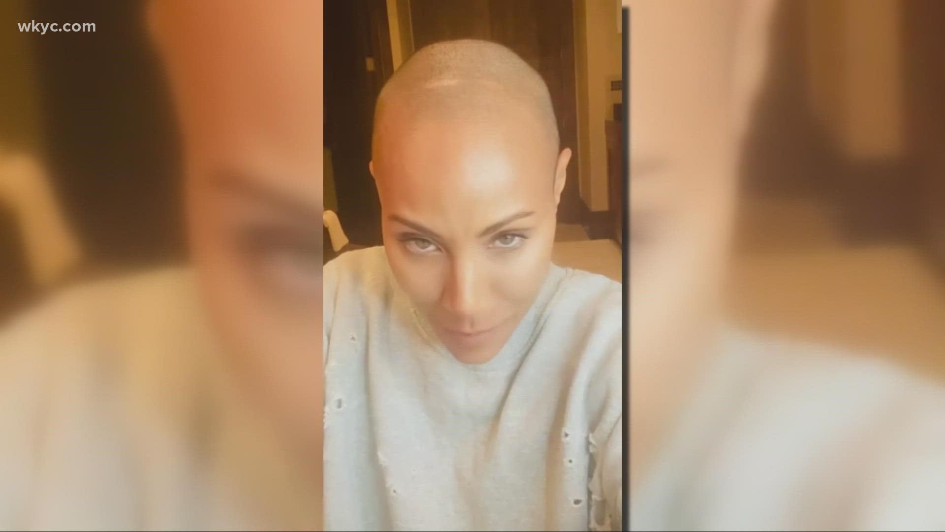 Jada Pinkett Smith recently opened up about her struggles with alopecia, an auto immune disease that causes hair loss and bald spots.